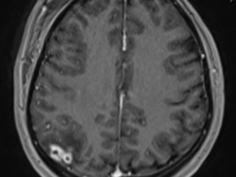 Imaging Case Answer: Neurocysticercosis
