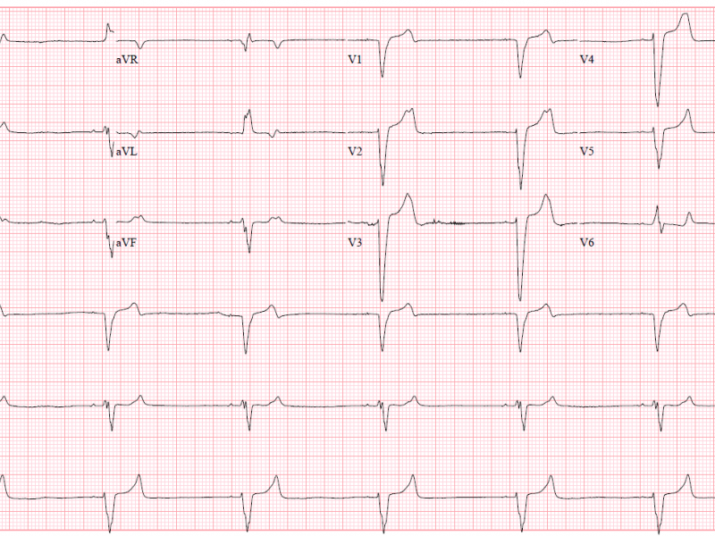 Critical Cases - BRASH Syndrome & Cardiac Arrest!