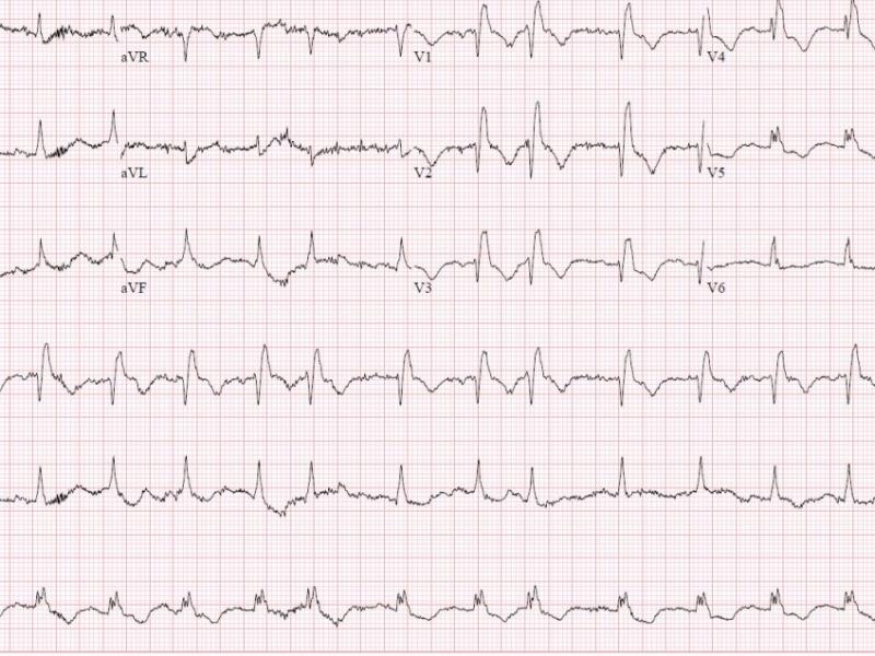 Critical Cases - Saddle Pulmonary Embolism!