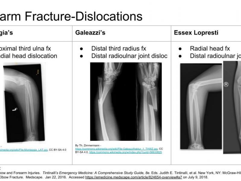 Back to Basics: Forearm Fracture-Dislocations