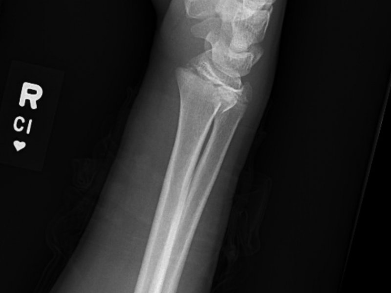 Imaging Case: 15 Year Old Girl with Right Wrist Pain