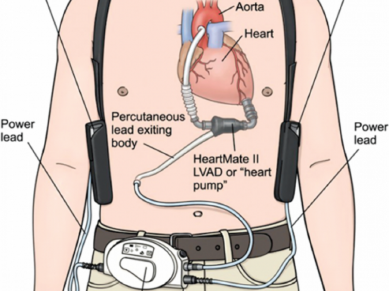 LVADs: Understanding the Basics