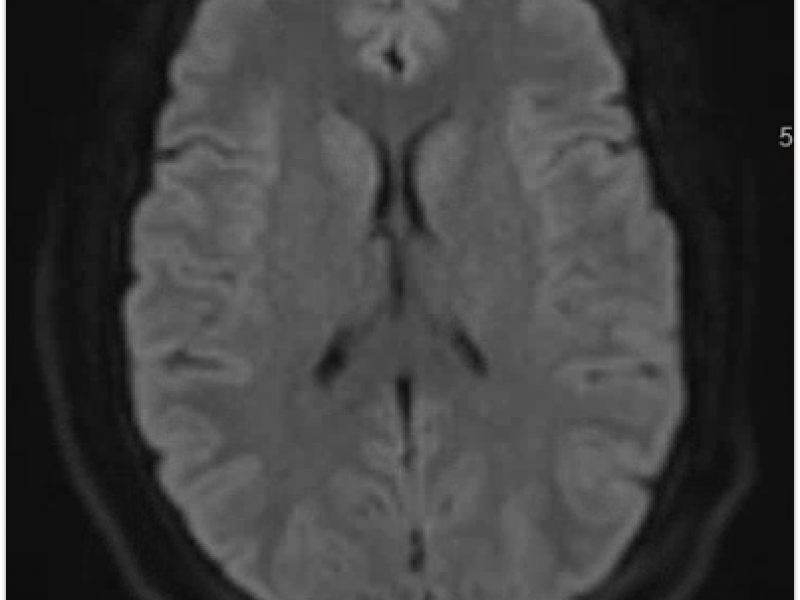 Critical Cases - Post LP Subdural Hematoma!