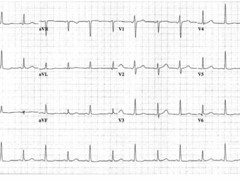 Cardiac Tamponade