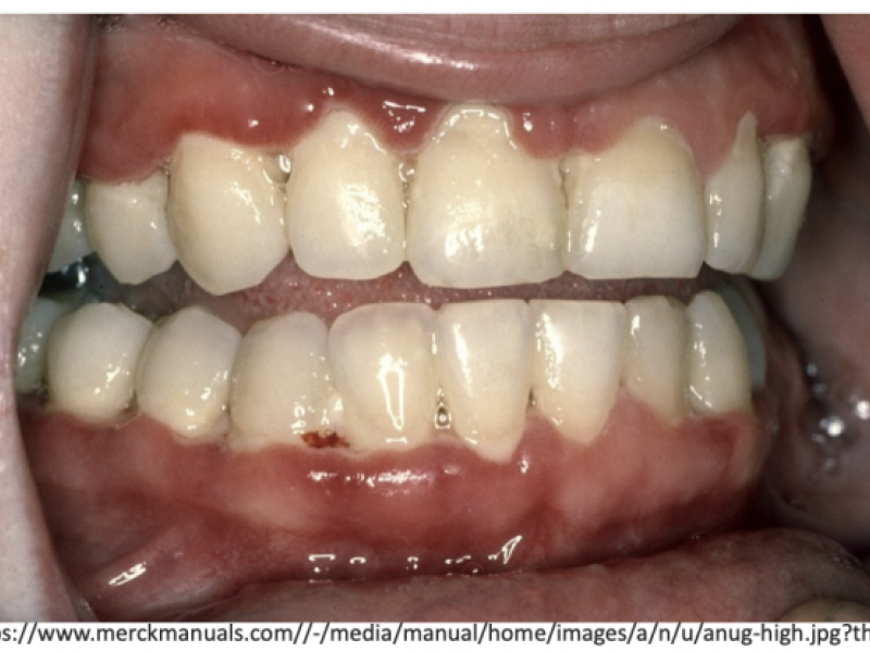 Back to Basics - Acute Necrotizing Ulcerative Gingivitis