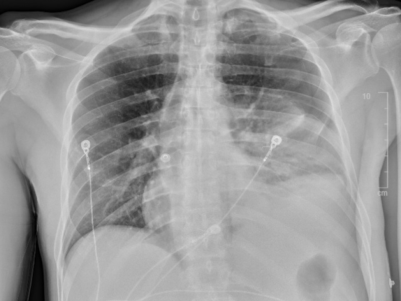 Critical Cases - Boerhaave's Syndrome Emergency!