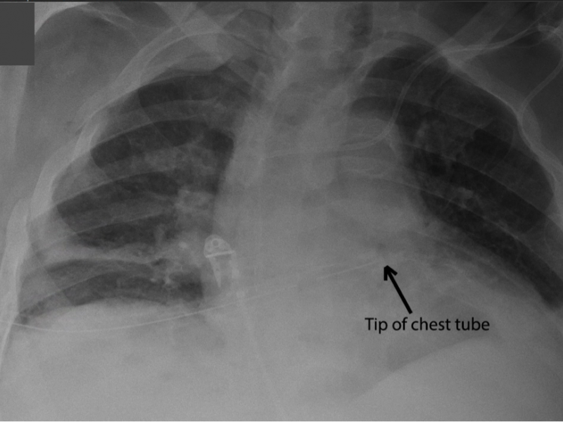 Back to Basics:  Chest Tube Insertion