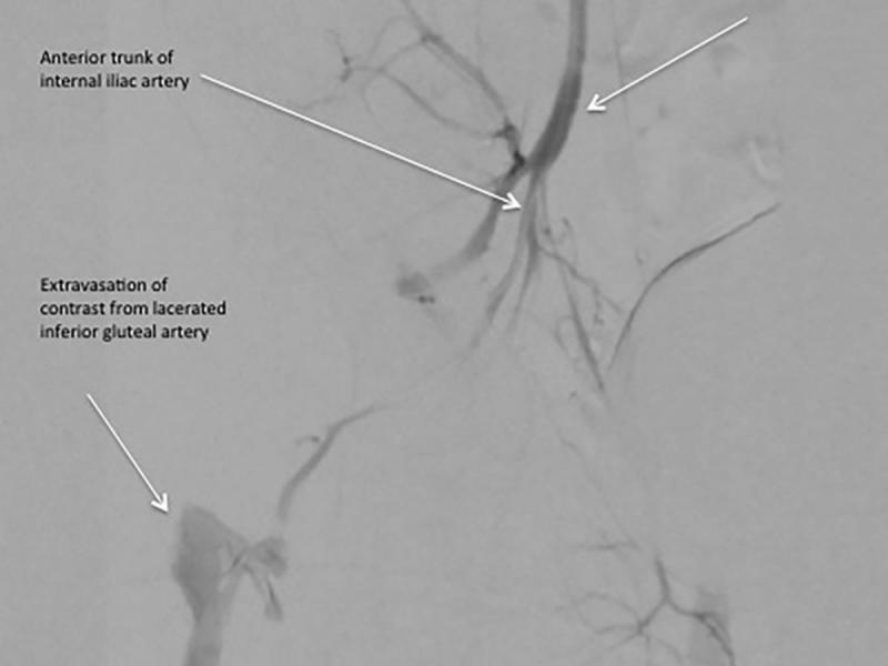 Critical Cases - Active Gluteal Muscle Internal Hemorrhage!