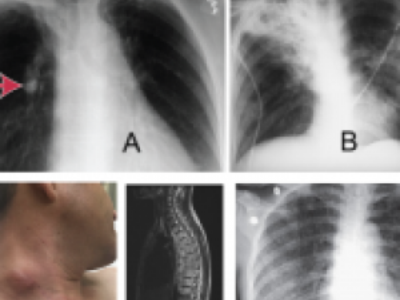 #EMConf: Tuberculosis 