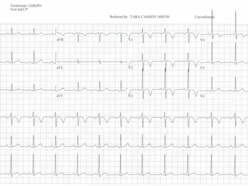 Advanced ECG interpretation: Wellens' Warning!